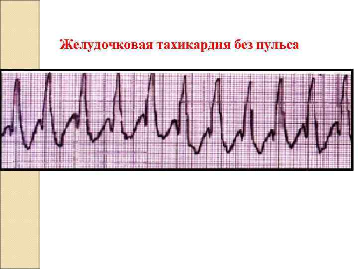 Желудочковая тахикардия без пульса 