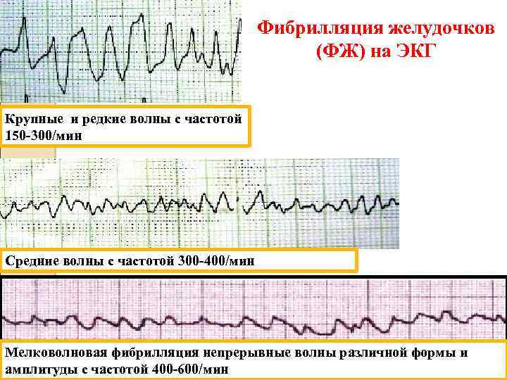 Фибрилляция желудочков (ФЖ) на ЭКГ Крупные и редкие волны с частотой 150 -300/мин Средние