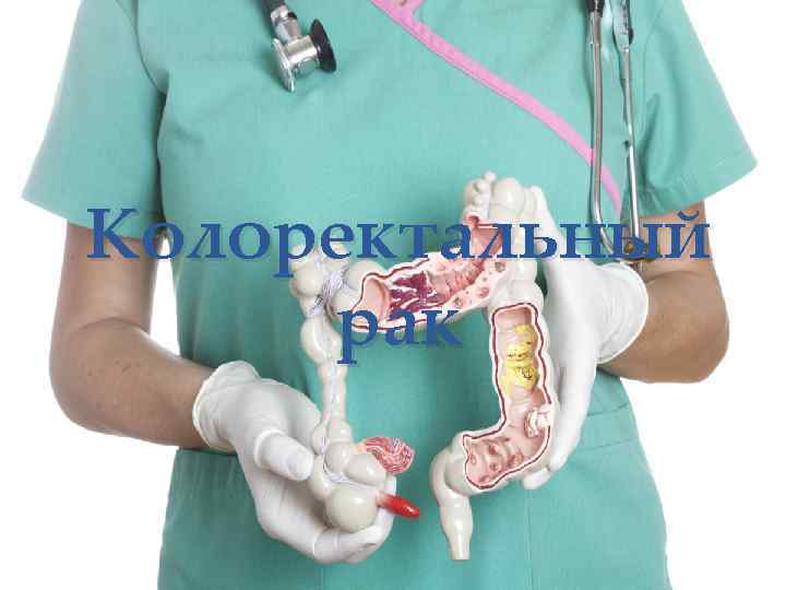 Колоректальный рак 