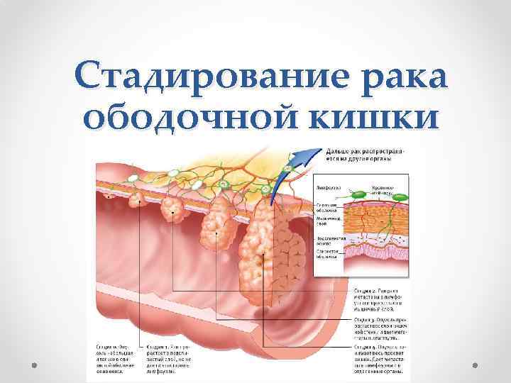 Стадирование рака ободочной кишки 