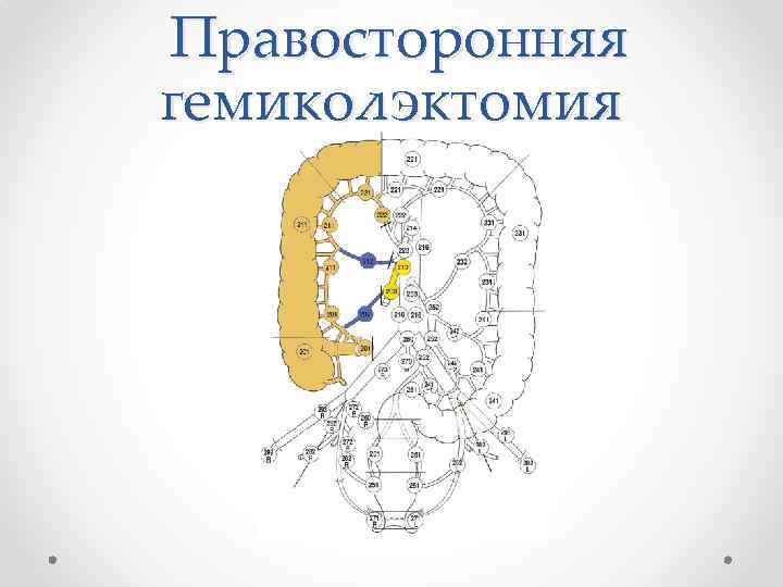Правосторонняя гемиколэктомия 