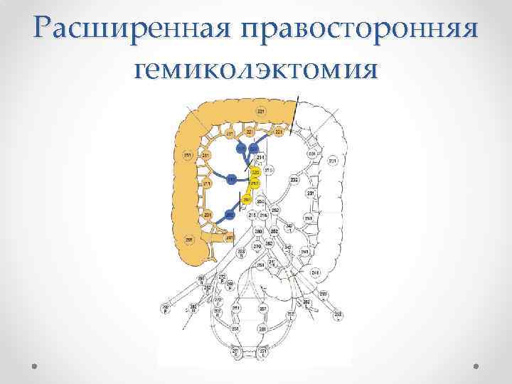 Расширенная правосторонняя гемиколэктомия 