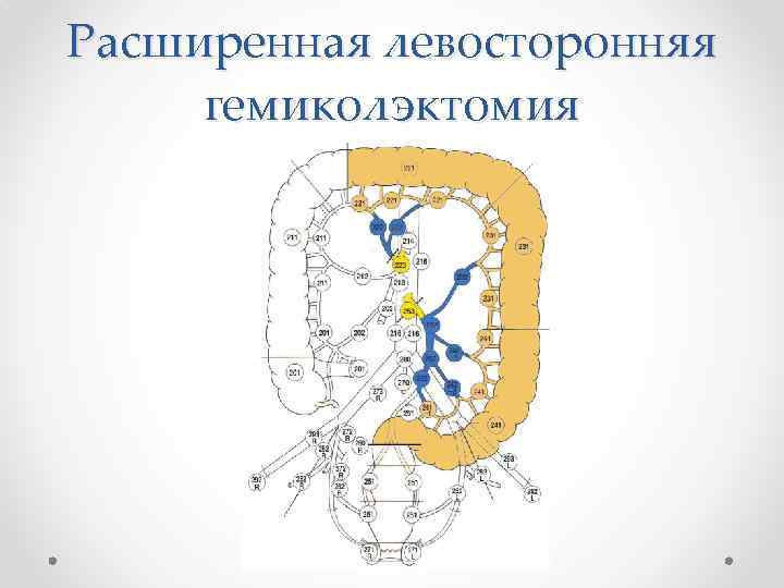Расширенная левосторонняя гемиколэктомия 