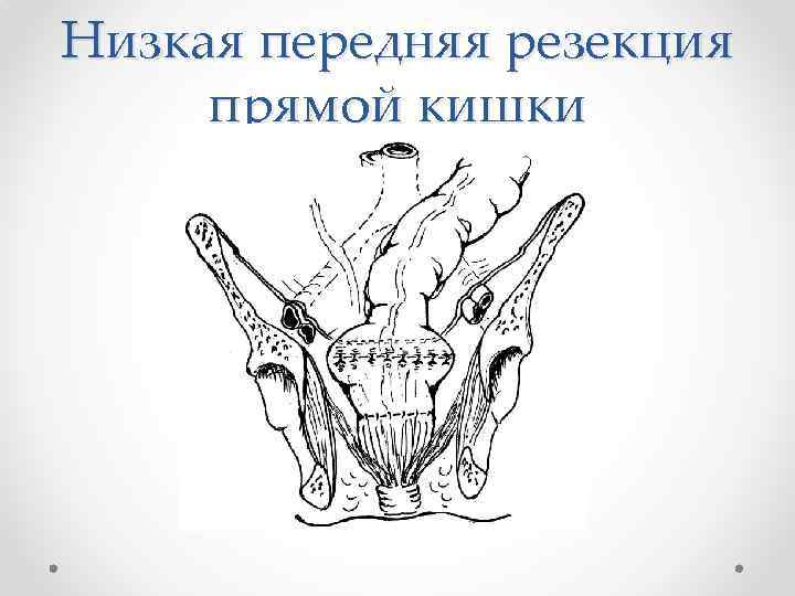 Низкая передняя резекция прямой кишки 