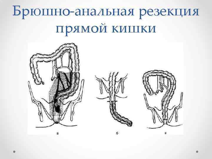 Брюшно-анальная резекция прямой кишки 