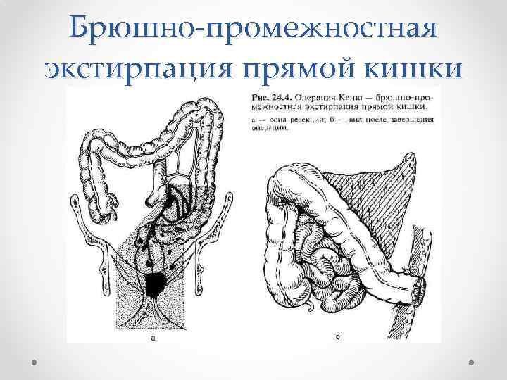 Брюшно-промежностная экстирпация прямой кишки 
