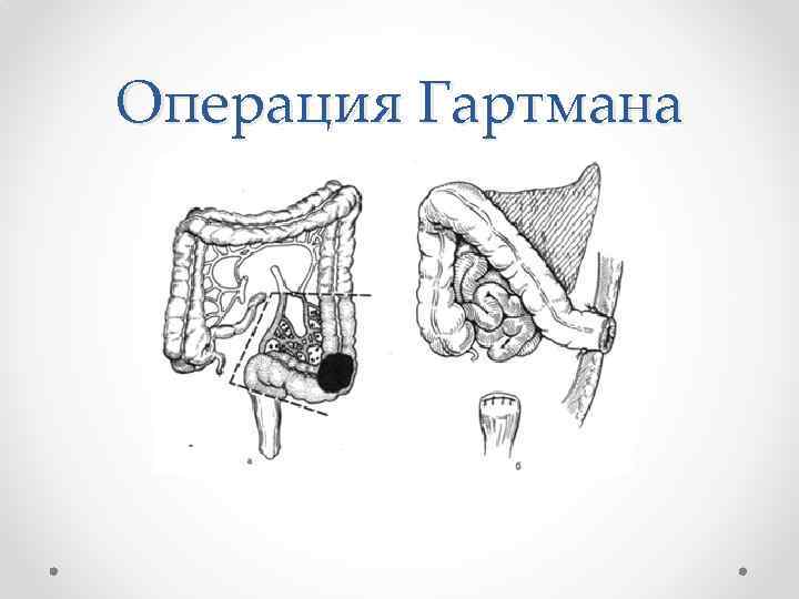 Операция Гартмана 