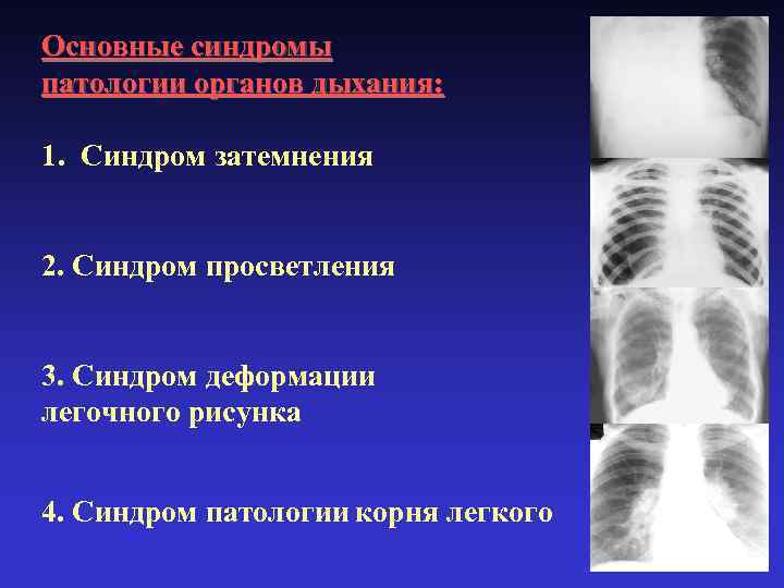 Основные синдромы патологии органов дыхания: 1. Синдром затемнения 2. Синдром просветления 3. Синдром деформации