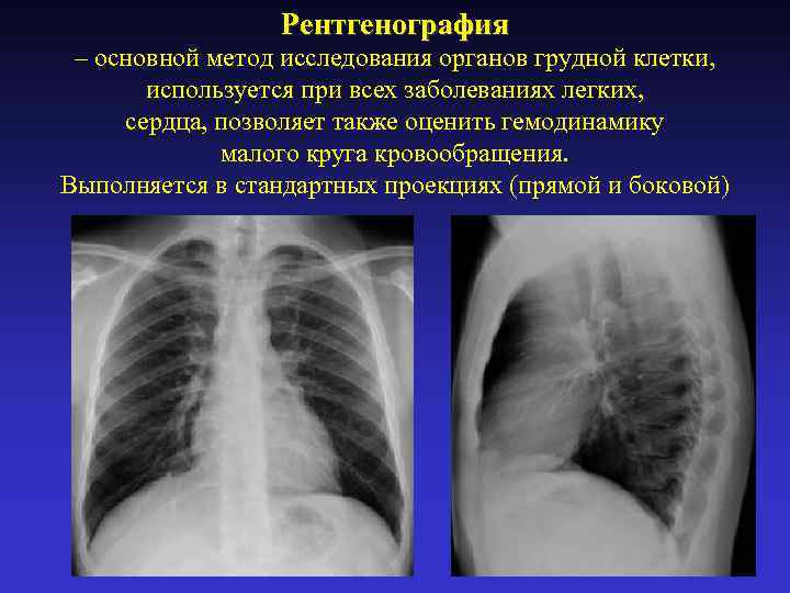 Исследование грудной клетки. Рентген исследование грудной клетки. Обзорная рентгенография органов грудной клетки в прямой проекции. Методы рентгенологического исследования органов грудной клетки. Рентгеноскопия органов грудной клетки.