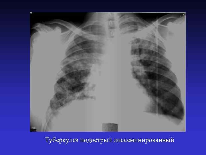 Туберкулез подострый диссеминированный 