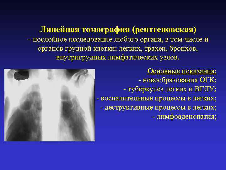 Линейная томография (рентгеновская) – послойное исследование любого органа, в том числе и органов грудной