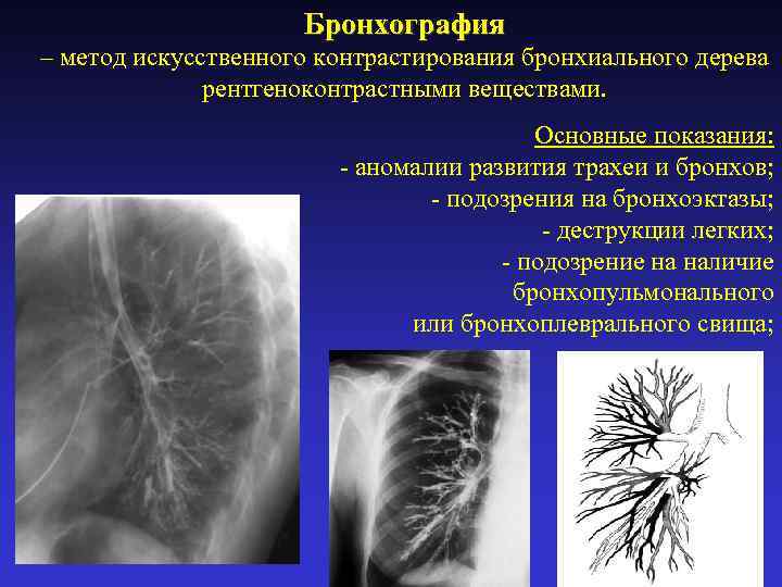 Бронхография – метод искусственного контрастирования бронхиального дерева рентгеноконтрастными веществами. Основные показания: - аномалии развития