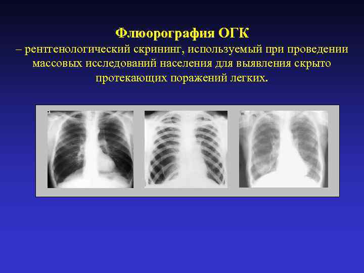 Флюорография ОГК – рентгенологический скрининг, используемый при проведении массовых исследований населения для выявления скрыто