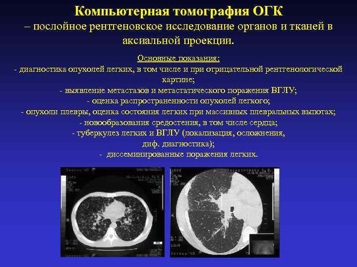 Компьютерная томография ОГК – послойное рентгеновское исследование органов и тканей в аксиальной проекции. Основные