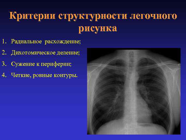 Критерии структурности легочного рисунка 1. Радиальное расхождение; 2. Дихотомическое деление; 3. Сужение к периферии;