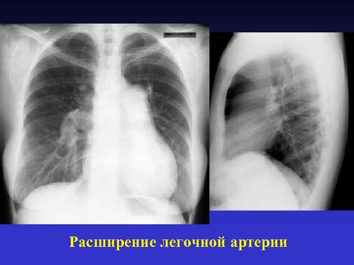 Расширение легочной артерии 