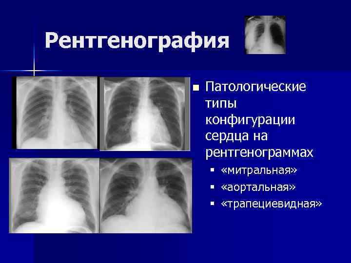 Рентгенография n Патологические типы конфигурации сердца на рентгенограммах § § § «митральная» «аортальная» «трапециевидная»