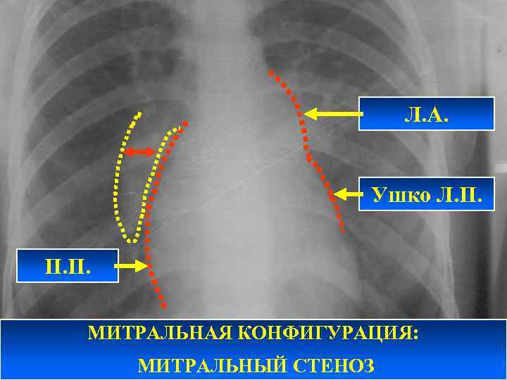 Л. А. Ушко Л. П. П. П. МИТРАЛЬНАЯ КОНФИГУРАЦИЯ: МИТРАЛЬНЫЙ СТЕНОЗ 