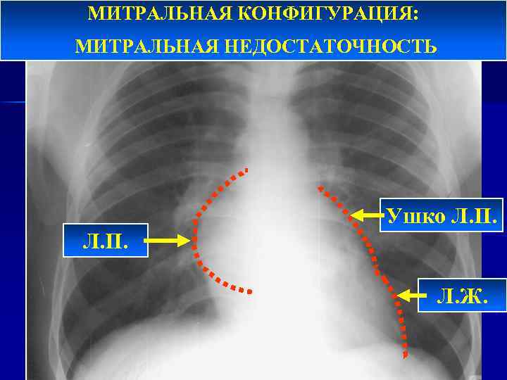 МИТРАЛЬНАЯ КОНФИГУРАЦИЯ: МИТРАЛЬНАЯ НЕДОСТАТОЧНОСТЬ Ушко Л. П. Л. Ж. 