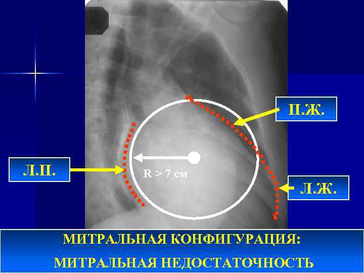 П. Ж. Л. П. R > 7 см Л. Ж. МИТРАЛЬНАЯ КОНФИГУРАЦИЯ: МИТРАЛЬНАЯ НЕДОСТАТОЧНОСТЬ