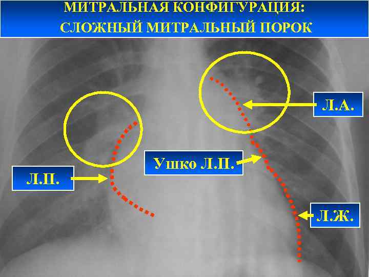 МИТРАЛЬНАЯ КОНФИГУРАЦИЯ: СЛОЖНЫЙ МИТРАЛЬНЫЙ ПОРОК Л. А. Л. П. Ушко Л. П. Л. Ж.