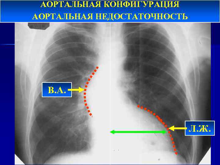 АОРТАЛЬНАЯ КОНФИГУРАЦИЯ АОРТАЛЬНАЯ НЕДОСТАТОЧНОСТЬ В. А. Л. Ж. 