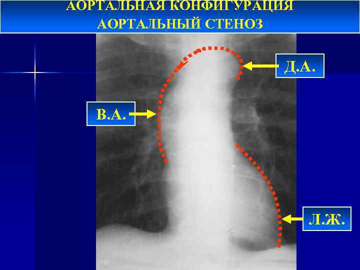 АОРТАЛЬНАЯ КОНФИГУРАЦИЯ АОРТАЛЬНЫЙ СТЕНОЗ Д. А. В. А. Л. Ж. 