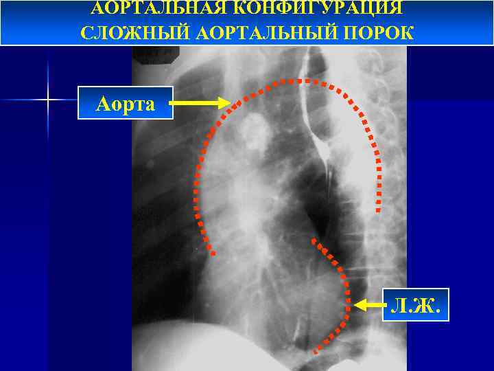 АОРТАЛЬНАЯ КОНФИГУРАЦИЯ СЛОЖНЫЙ АОРТАЛЬНЫЙ ПОРОК Аорта Л. Ж. 