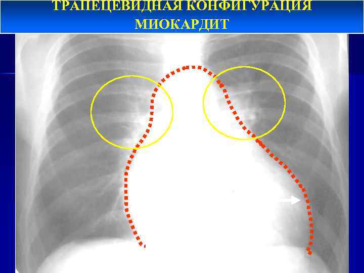 ТРАПЕЦЕВИДНАЯ КОНФИГУРАЦИЯ МИОКАРДИТ 