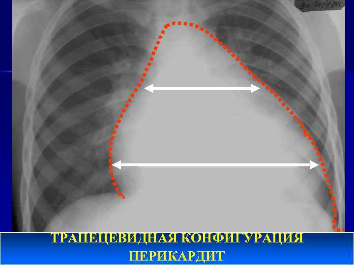 ТРАПЕЦЕВИДНАЯ КОНФИГУРАЦИЯ ПЕРИКАРДИТ 