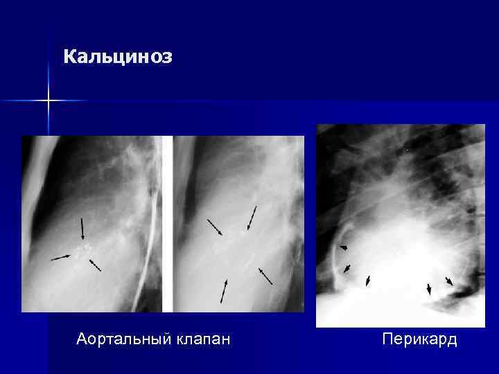 Кальциноз Аортальный клапан Перикард 