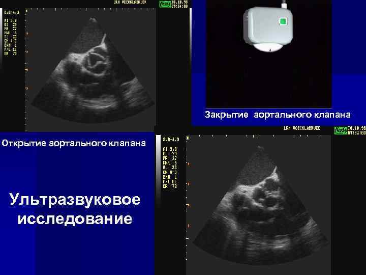 Закрытие аортального клапана Открытие аортального клапана Ультразвуковое исследование 