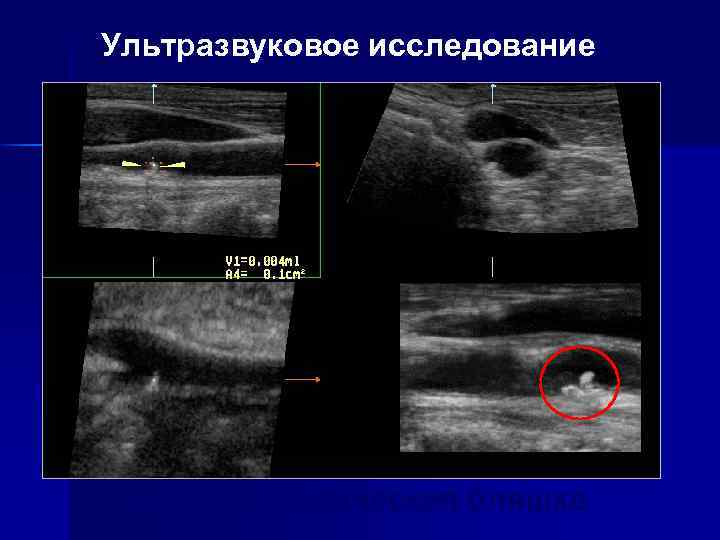 Ультразвуковое исследование Атеросклеротическая бляшка 