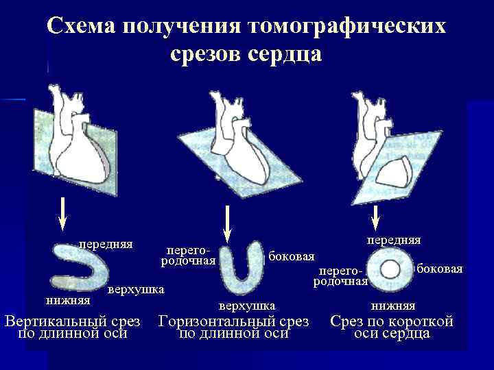 Схема получения томографических срезов сердца передняя нижняя перегородочная передняя боковая верхушка Вертикальный срез по