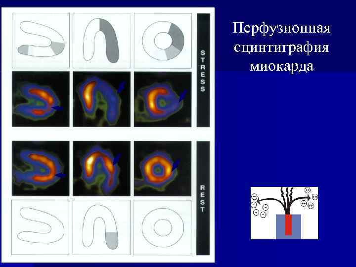 Перфузионная сцинтиграфия миокарда 