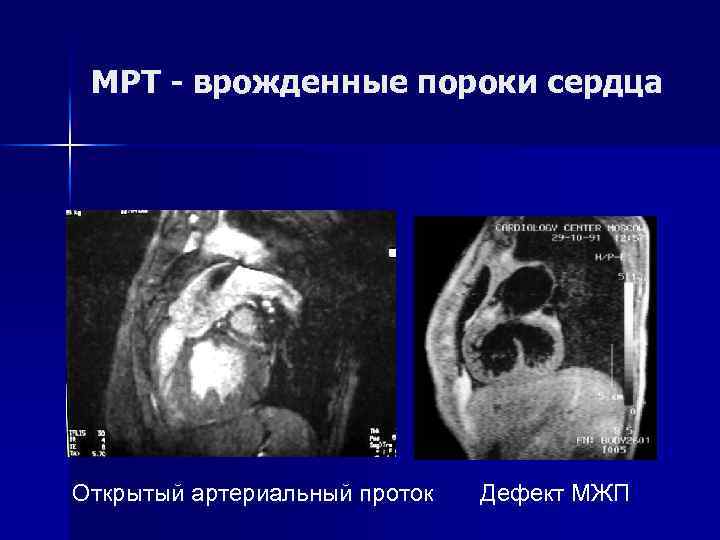 МРТ - врожденные пороки сердца Открытый артериальный проток Дефект МЖП 