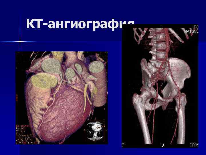 КТ-ангиография 