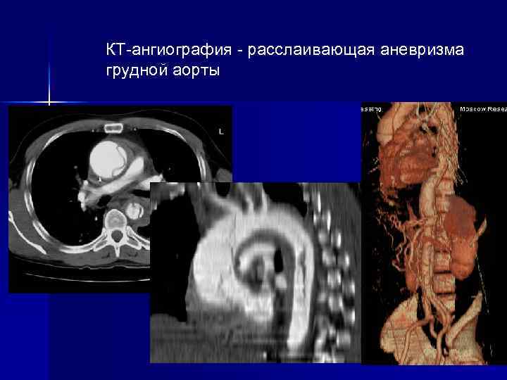 КТ-ангиография - расслаивающая аневризма грудной аорты 