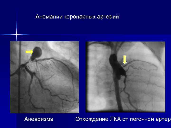 Аномалии коронарных артерий Аневризма Отхождение ЛКА от легочной артери Аневризма Отхождение ЛКА от легочной