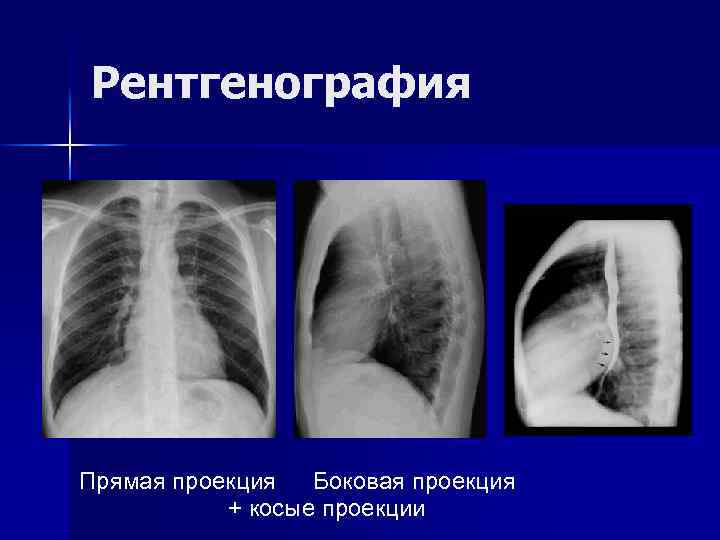 Рентгенография Прямая проекция Боковая проекция + косые проекции 