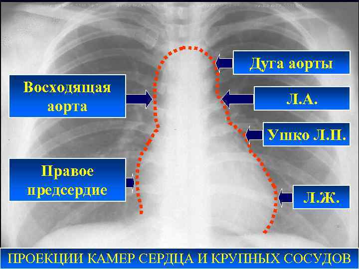 Дуга аорты Восходящая аорта Л. А. Ушко Л. П. Правое предсердие Л. Ж. ПРОЕКЦИИ