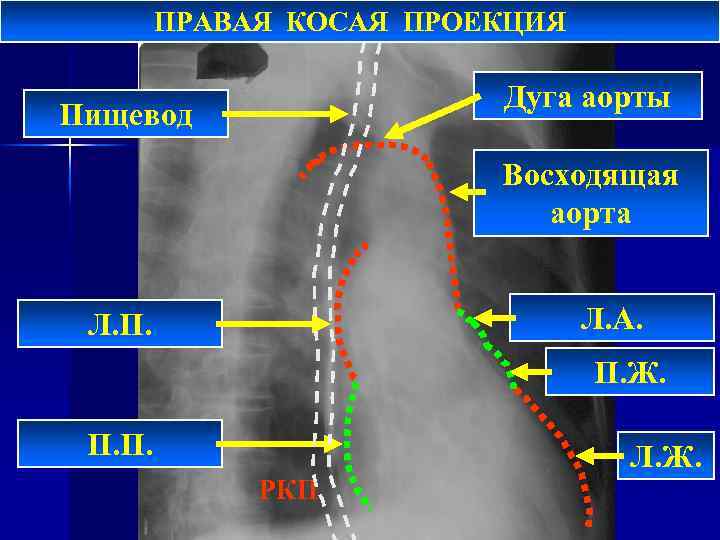 ПРАВАЯ КОСАЯ ПРОЕКЦИЯ Дуга аорты Пищевод Восходящая аорта Л. А. Л. П. Ж. П.