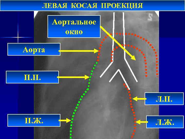 ЛЕВАЯ КОСАЯ ПРОЕКЦИЯ Аортальное окно Аорта П. П. Л. П. П. Ж. Л. Ж.