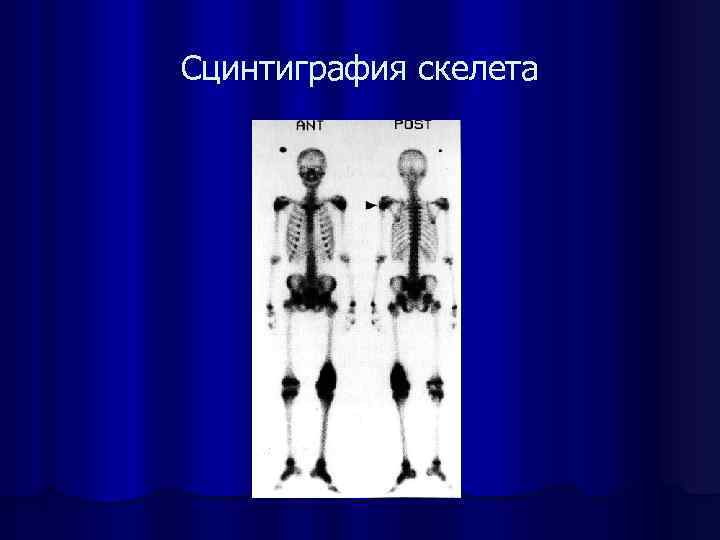 Сцинтиграфия скелета 