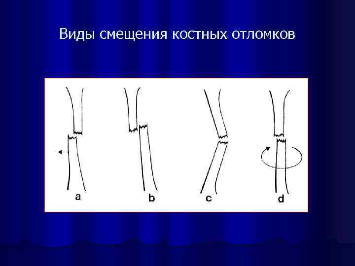 Смещение отломков кости. Типы смещения костных отломков. Тип смещения отломков. Виды смещения отломков костей. Виды смнщения костчнных обломков.