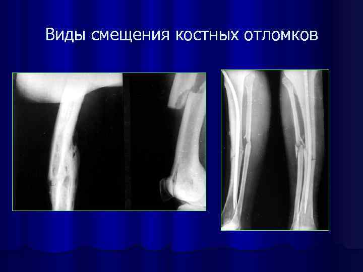 Смещение отломков кости. Основные типы смещения костных отломков. Степени смещения костных отломков. Виды смещения отломков костей. Ротационное смещение костных отломков.