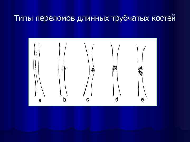 Типы переломов длинных трубчатых костей 