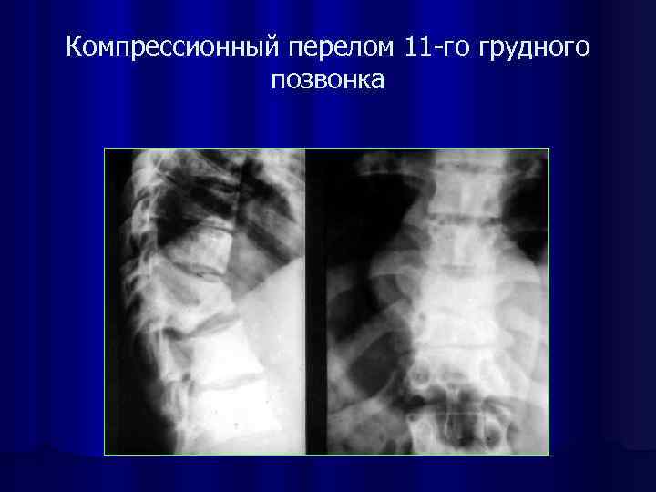 Компрессионный перелом это. Компрессионный перелом. Горб компрессионный перелом позвоночника. Компрессионный перелом 11 позвонка. Осложнения компрессионного перелома позвоночника грудного отдела.