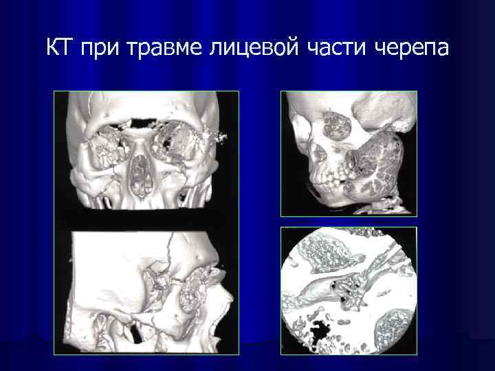 КТ при травме лицевой части черепа 