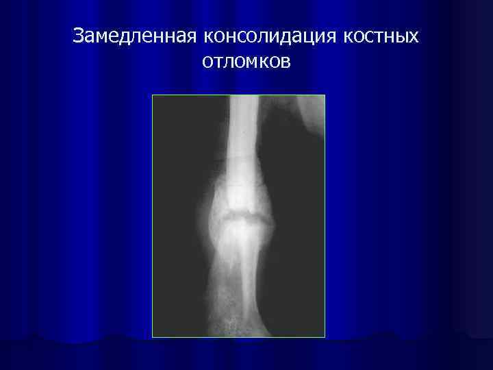Что такое консолидация перелома. Периостальная костная мозоль. Замедленная консолидация переломов и ложные суставы. Степень консолидации перелома рентген. Периостальная костная мозоль кт.